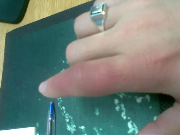 Bruised swollen forefinger after football injury