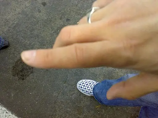 Finger recovered no bruising