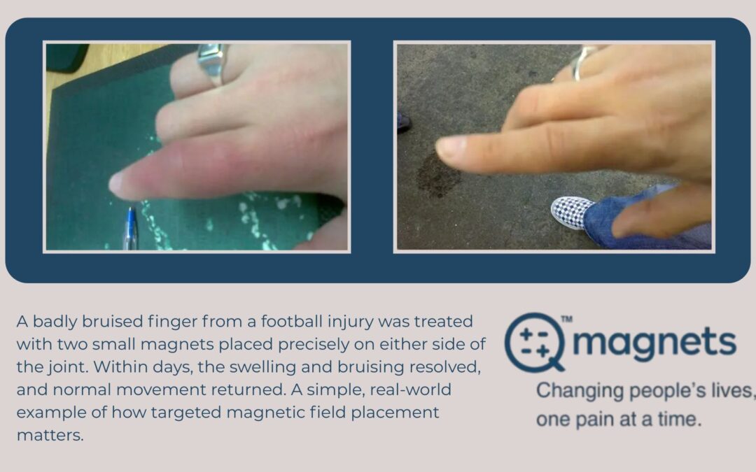 How a Simple Magnet Setup Helped a Bruised Finger Recover Faster
