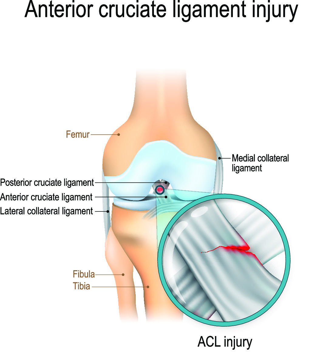 ACL injury illustration showing knee ligament trauma