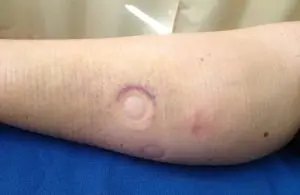 Gastrocnemius strain treatment with magnetic therapy