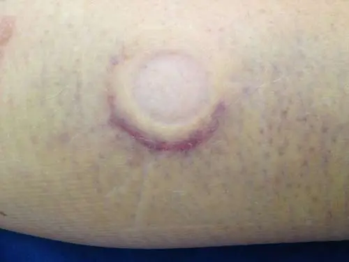 Q Magnets applied for calf bruise and soft tissue injury recovery