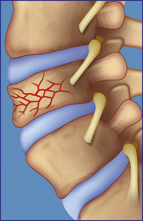 Compression fracture and disc bulge illustration relevant to lower back pain