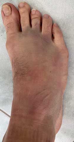 3 days post Q Magnets application for soft tissue injury healing