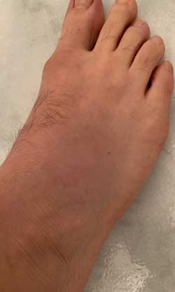 foot soft tissue injury recovery with Q Magnetic field therapy