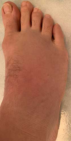 1 day post Q Magnets application for soft tissue injury recovery