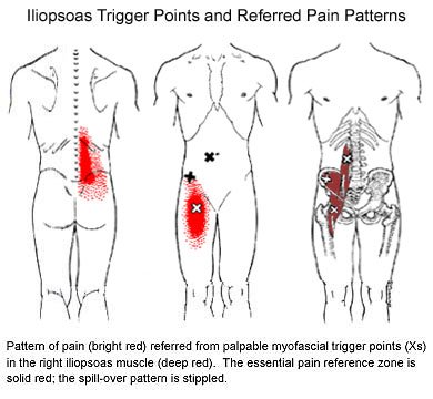 iliopsoas magnetic therapy application