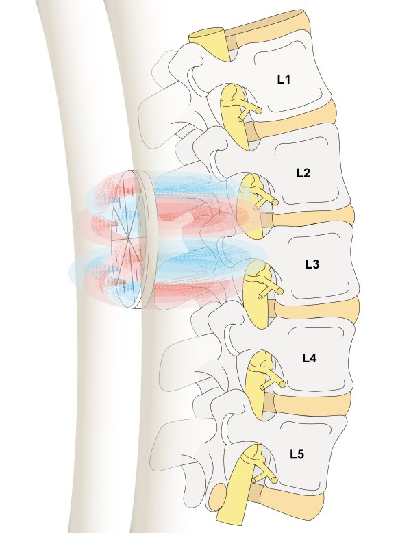 octapolar 50 magnets for back pain by q magnets australia united states canada united kingdom europe taiwan OF50-3 for Back Pain Treatment using Magnetic Therapy