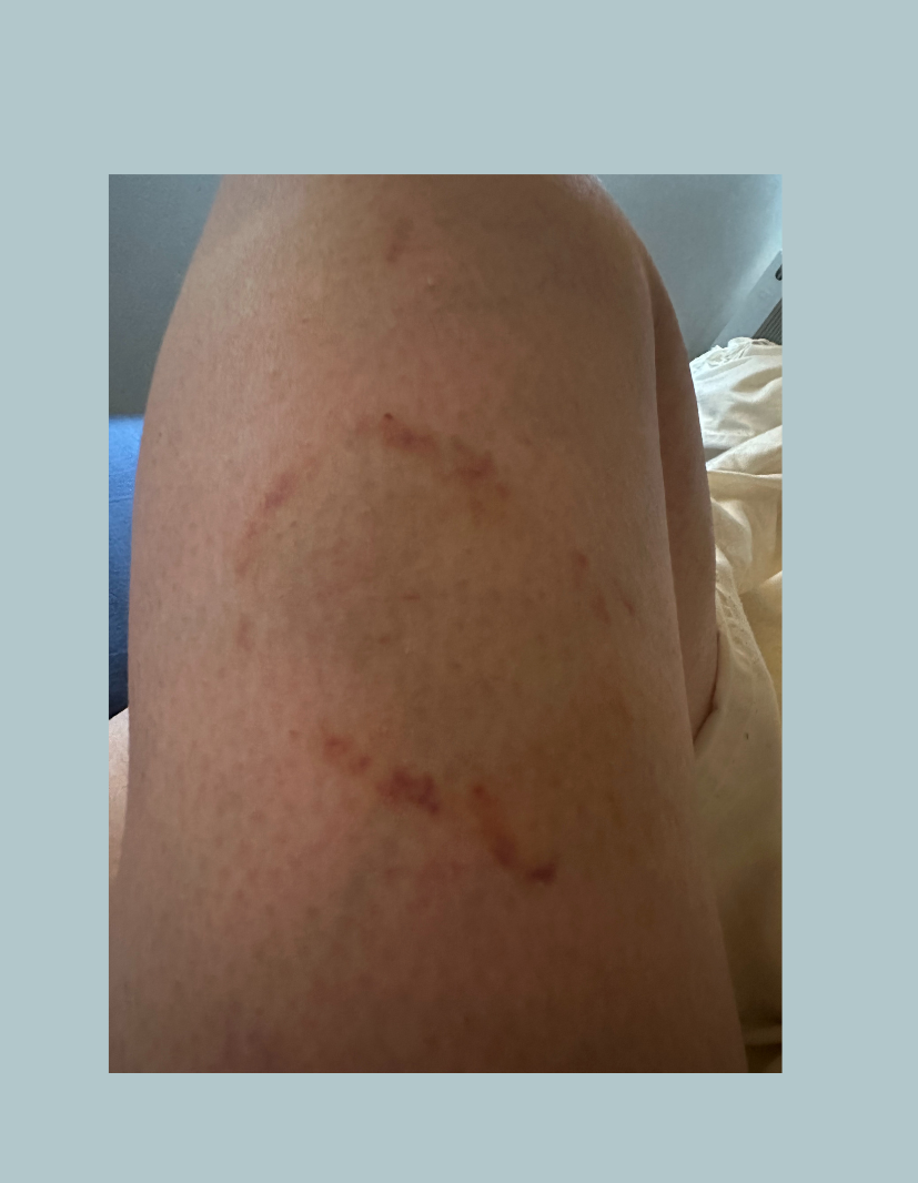 Improved bruising after magnet use