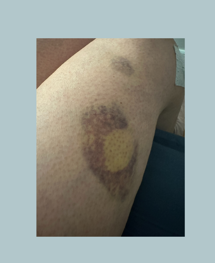 Bruising without magnet applied