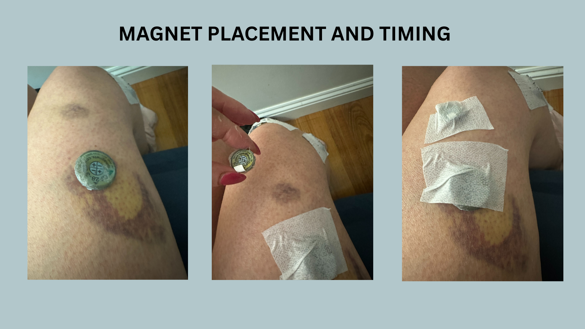 Magnet placed over bruised tissue