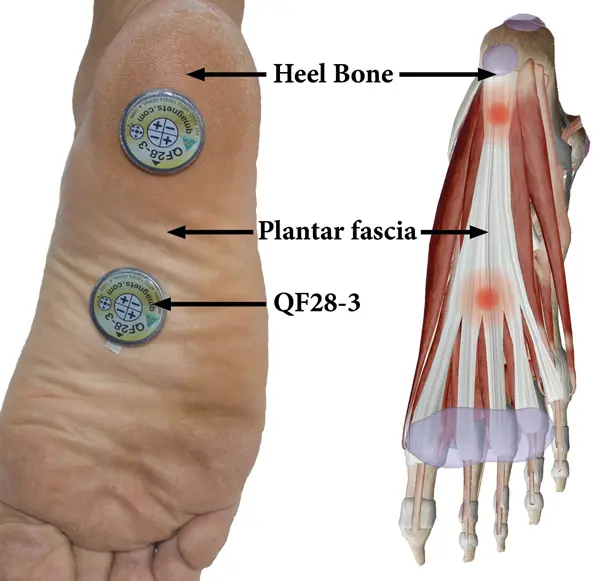 Athlete experiencing plantar fasciitis heel pain