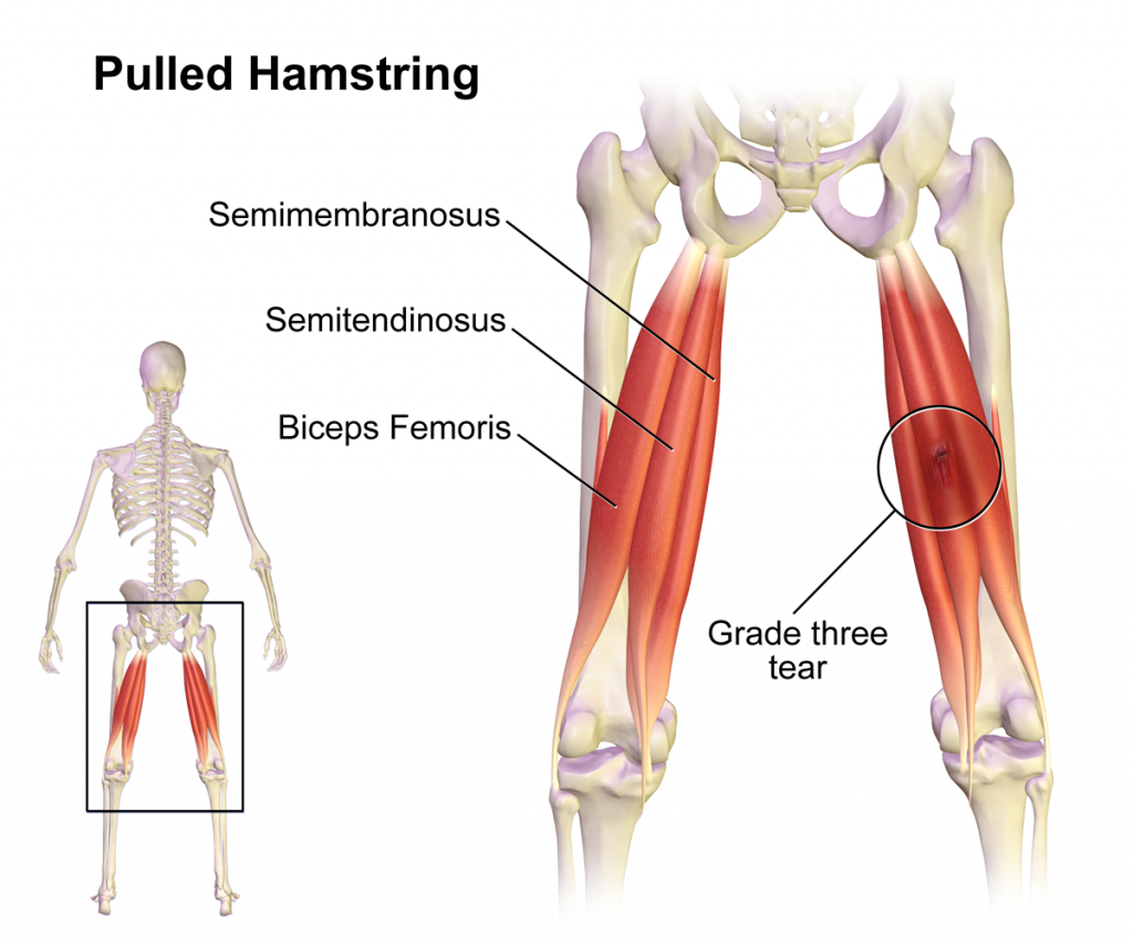 Pulled hamstring muscle illustration for magnetic therapy support