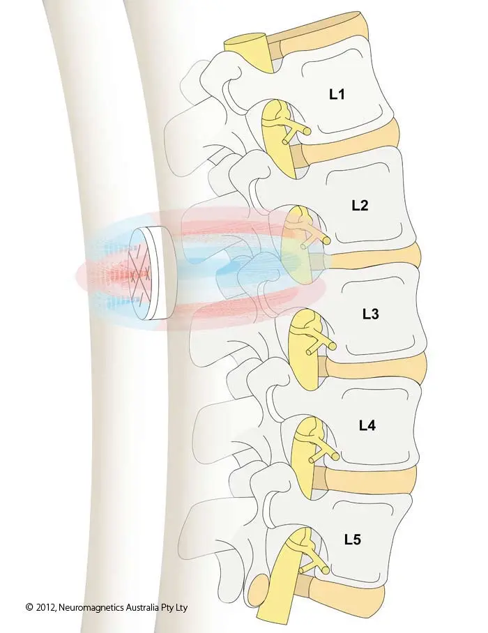 Magnetic Therapy for low back pain with Quadrapolar Q Magnets