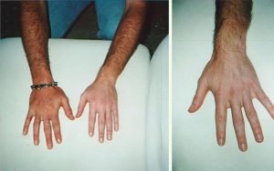 Before and after effects of Q Magnet therapy on sympathetic nervous system overload