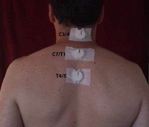Q Magnet placement for sympathetic nervous system overload