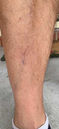 shin injury recovery biomagnets
