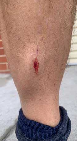 foot soft tissue injury recovery with Q Magnetic field therapy