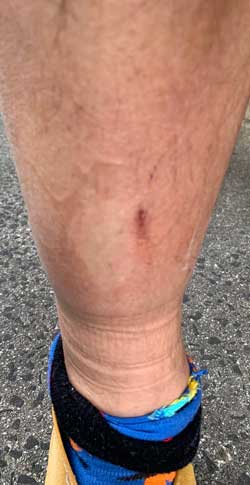 Shin injury magnetic field therapy