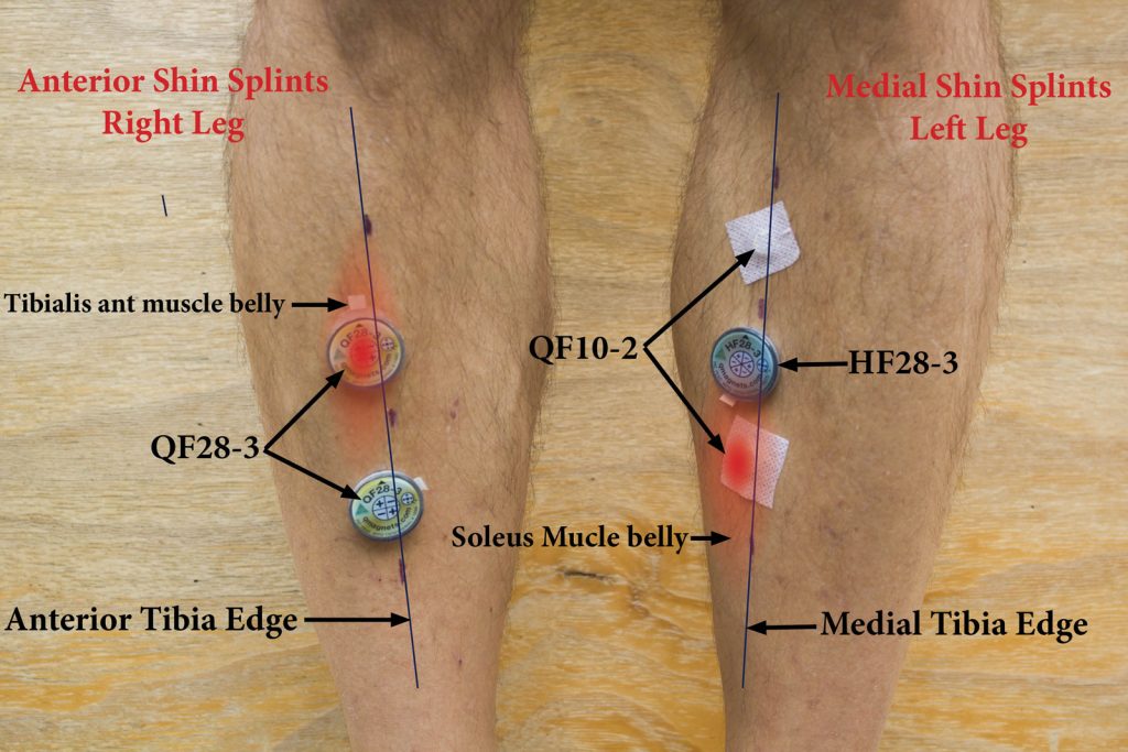 Q Magnet therapy for minor shin soreness