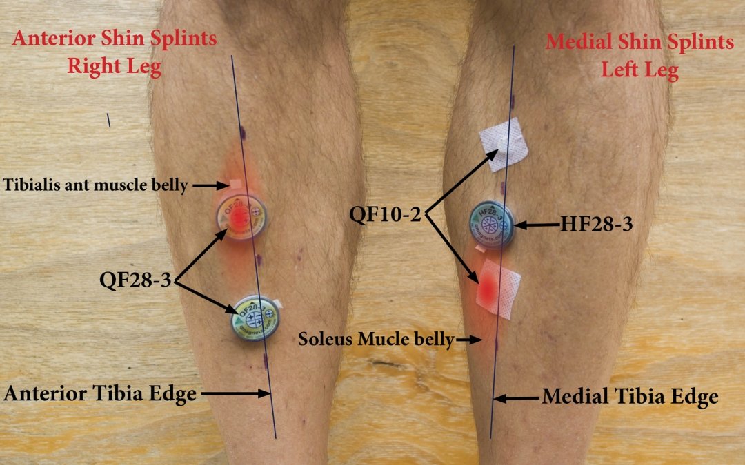 Q Magnet therapy for minor shin soreness