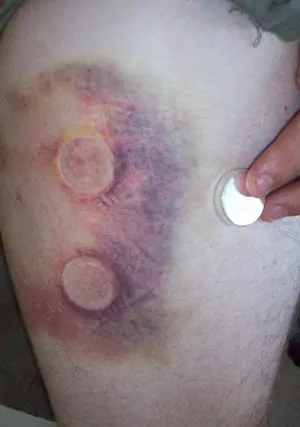 Corked thigh injury recovery using Q Magnets on motocross athlete