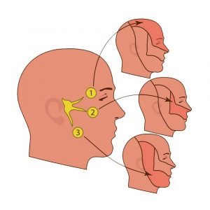 Trigeminal Neuralgia TMJ Pain Magnetic therapy