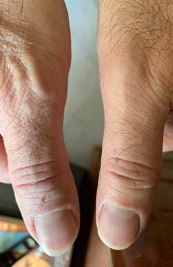 Strained Thumb recovery with Q Magnets