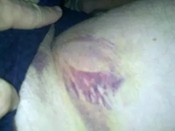 Groin bruise after 24 hours of Q Magnet application