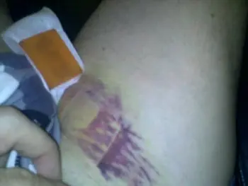 Change in peripheral bleeding into skin after Q Magnet application