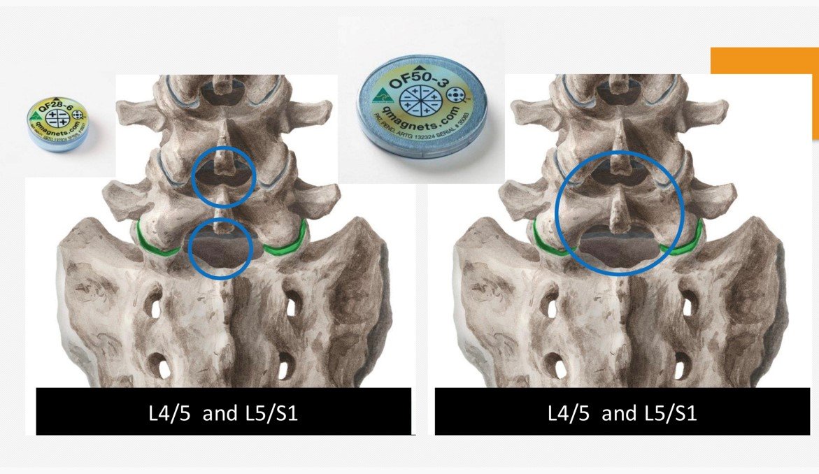 spinal disc treatment with magnetic therapy