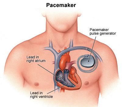 Magnetic Therapy Contraindication - Pacemaker