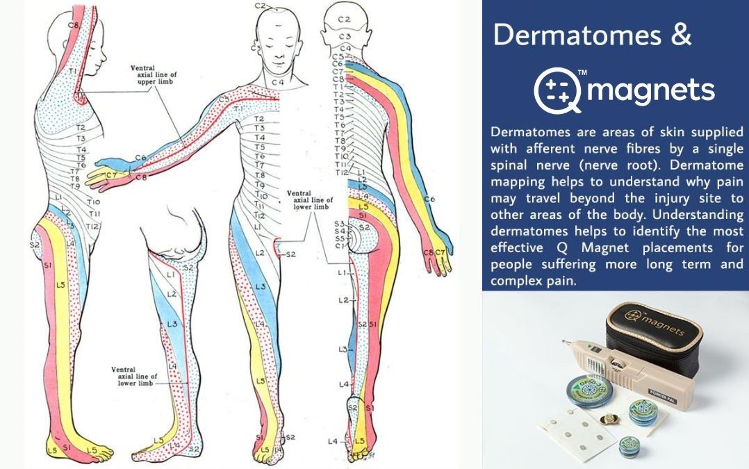 Dermatomes – How dermatomes affect Q Magnet application for treating chronic and persistent pain