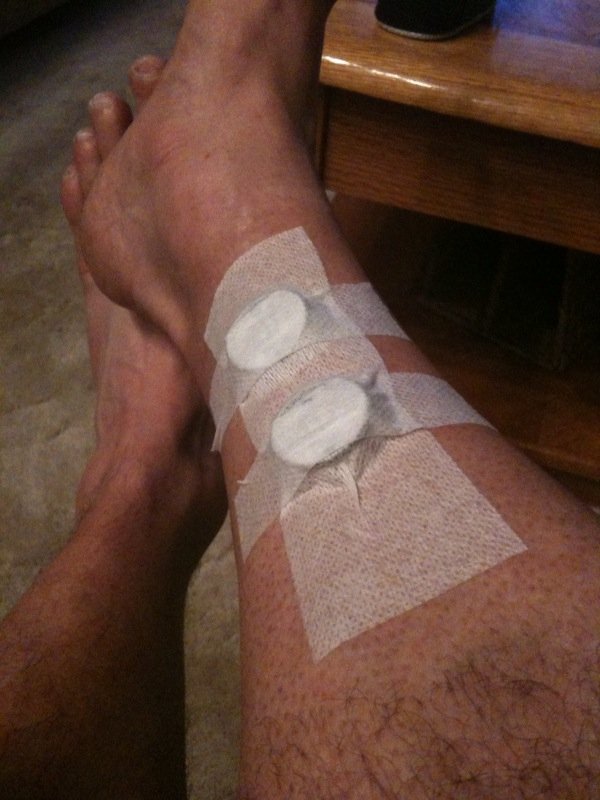 Two ProQ's taped over tibia with Hypafix tape